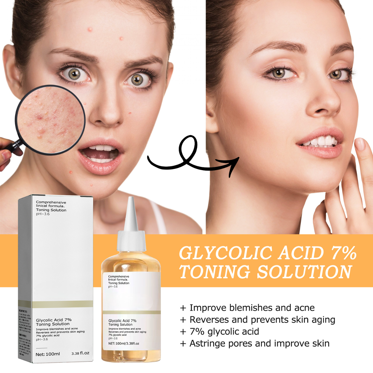 Glycolic Acid Acne Lotion